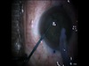 Laser Refractive Cataract Surgery - Case 2