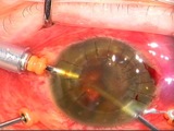 Traumatic PKP Graft Dislocation, Vitreous Hemorrhage, and Retinal Detachment