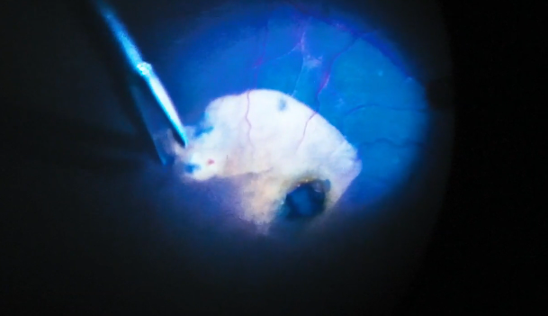 The Big Mac: ILM Technique for Large Macular Holes