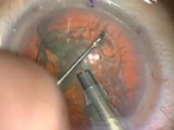 A New View of Phaco Using the Zeiss Lumera Microscope