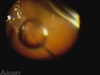 Small Orbit Challenges: Intraop Choroidals
