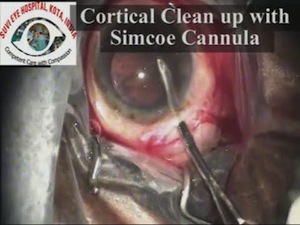 Small Incision Cataract Surgery Fishhook Technique