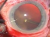 Scleral Depressed Vitreous Shaving