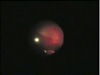 360 Degree Giant Retina Tear