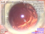 Vitrectomy Pearls After Capsule Tears