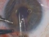 DREKT Surgery