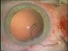The Capsular Tension Ring