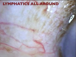 Lymphatics in Glaucoma Surgery