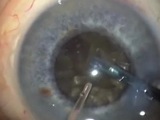 Micro-chop in Brunescent Cataract