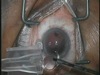 AMO Microimplantation Suite