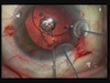 Reverse Pupillary Block