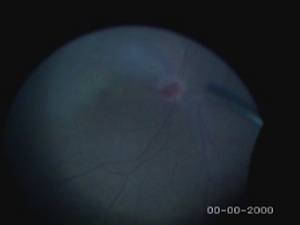 Cholesterol Embolus Extraction from Temporal Retinal Artery at Papillary Level