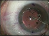 Implantation of a New CIMflexTc Toric IOL Currently in Clinical Trials