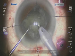 My First Combined Surgery Using CVS 27 Gauge 7500 cpm Ultravit Cutter