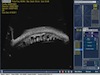 Ciliary Cyst - Part 2