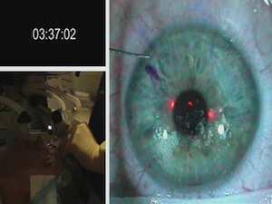 Real-time Bilateral LASIK Procedure with the VisuMax Femtosecond Laser and MEL 80 Excimer Laser