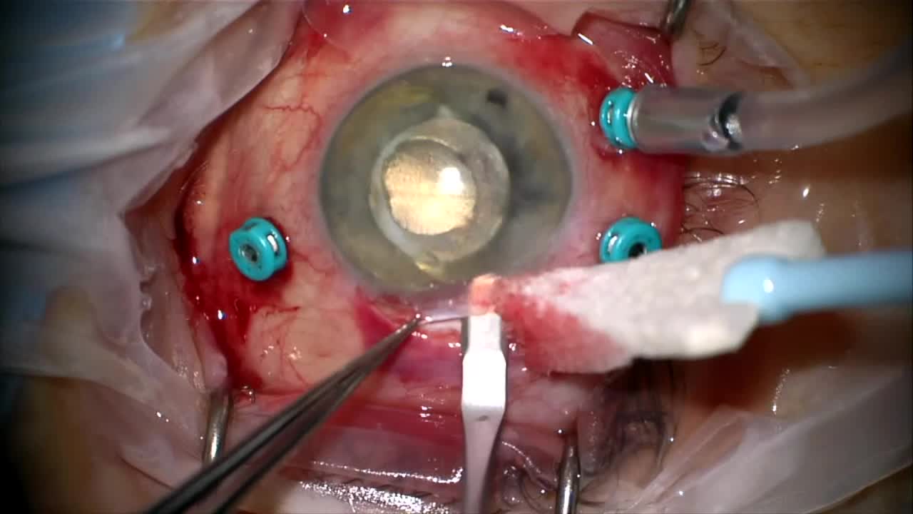 Removal of a Dislocated IOL