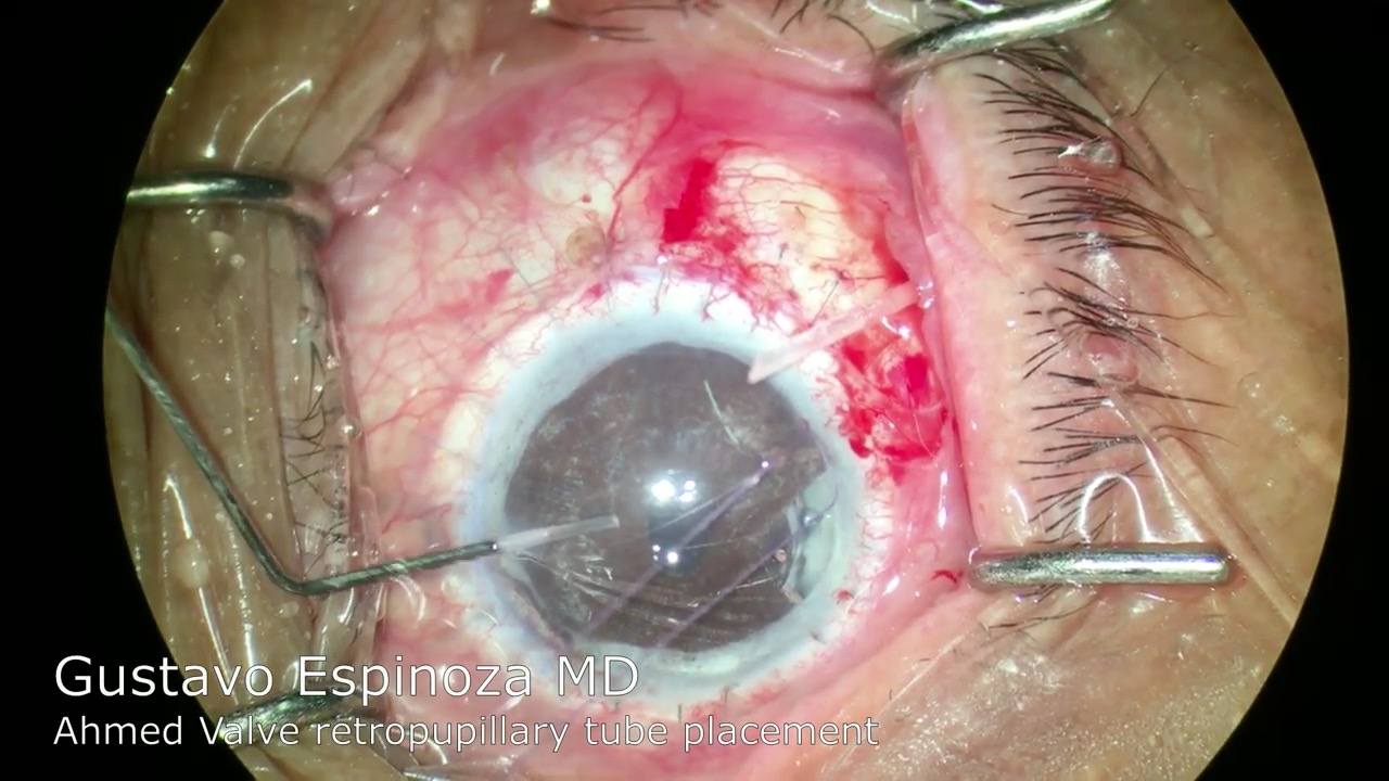 Ahmed Valve Retropupillary Tube Placement for Post PKP Glaucoma