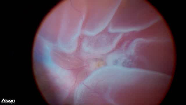 PVR RD from Toxoplasmosis - Eyetube