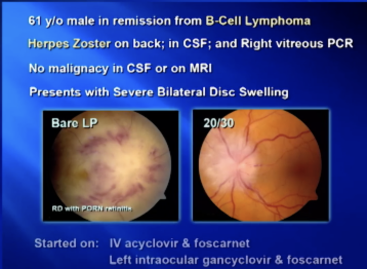 Optic Nerve Biopsy