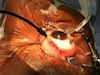 Independent Surgery of the Retina and Vitreous