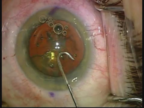 Cortex Club for Femtosecond Laser Cataract Surgery