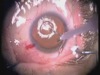 Tear Film Phaco