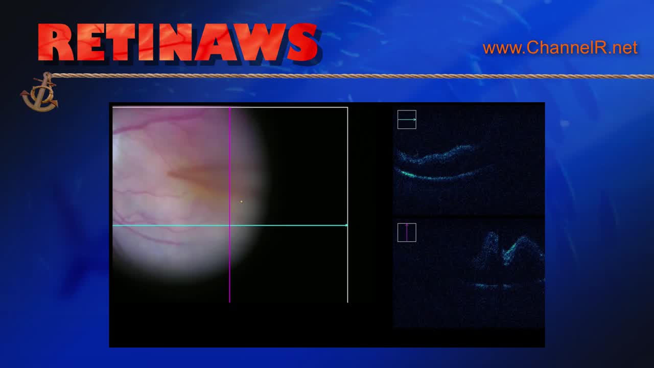 Macular Fold