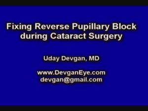 Fixing Reverse Pupillary Block