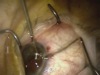 Management Of Dislocated IOL-Capsular Bag Complex And Glaucoma In Pseudoexfoliation Syndrome
