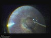 Morning Glory Syndrome with Macular Hole and PVR