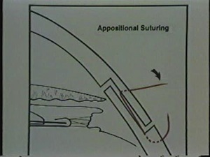 Deep vs Appositional Suturing