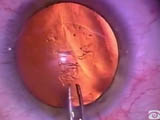 Ring Caliper for a Calibrated and Centrated Anterior Rhexis