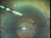 Subluxated IOL to Glued IOL in an Eye Surgeon