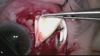Combined Vitrectomy and Pars Plana Shunt Implants for Neovascular Glaucoma