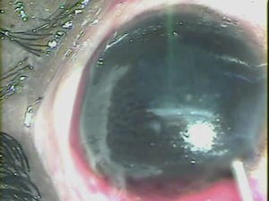 Old Traumatic Cataract