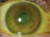Make it Stop - Techniques to Treat and Prevent the Recurrence of Epithelial Ingrowth Post-LASIK