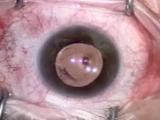 23-gauge MIVS repair of Rhegmatagenous Retinal Detachment
