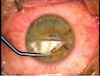 LASIK Enchancement - Lifiting the Flap