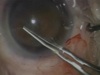 Astigmatic Reduction: Toric IOL - Part 1