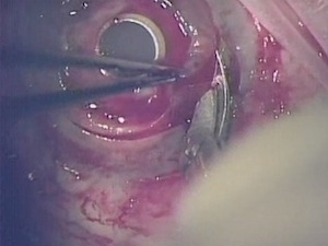 Removal of KPro and Placement of Tectonic PKP Due to Corneal Melt