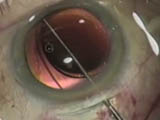 A new instrument and technique for implanting single piece lenses into the capsular bag
