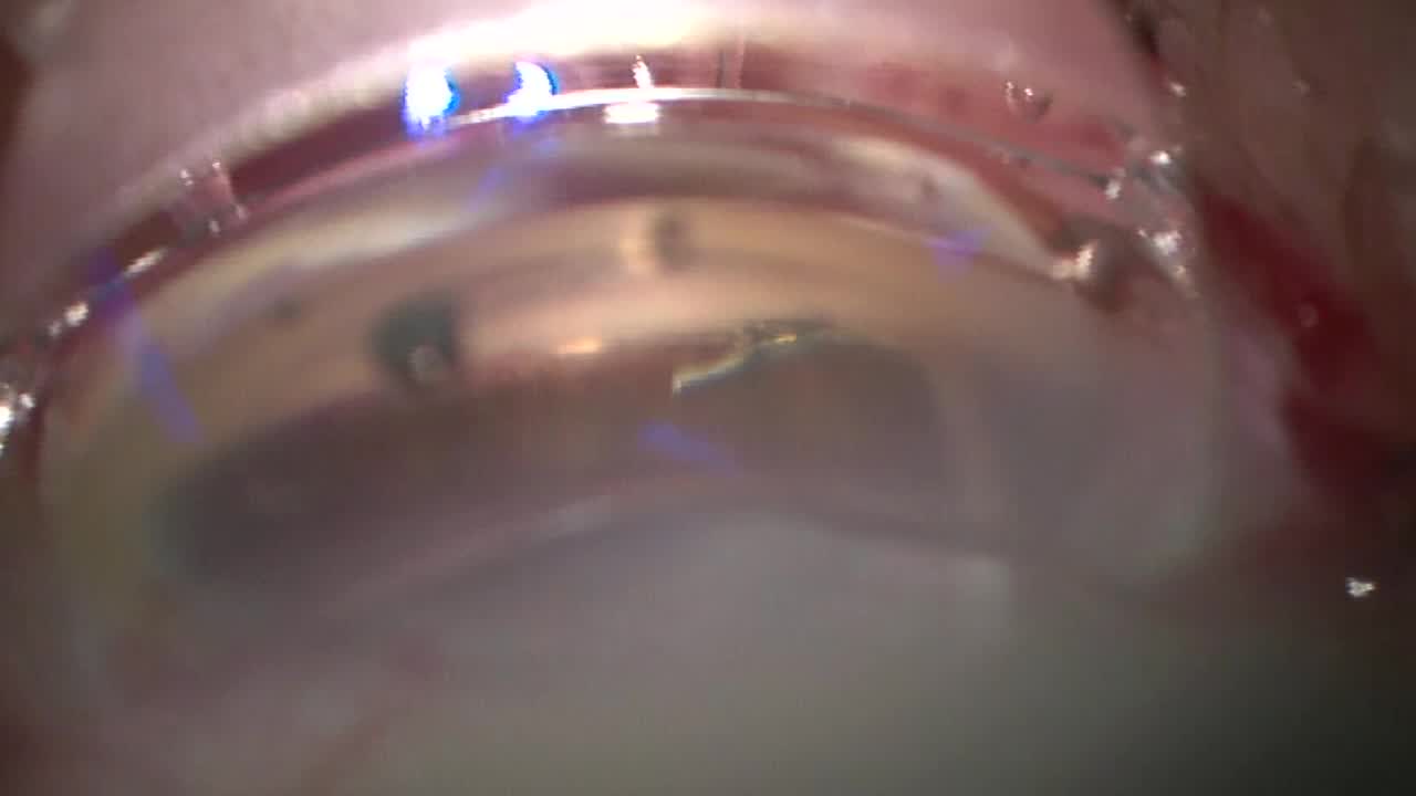 Implantation of a Hydrus Microshunt in a Premium Cataract Surgery