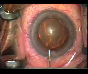 Preventing Iris Prolapse from Positive Pressure