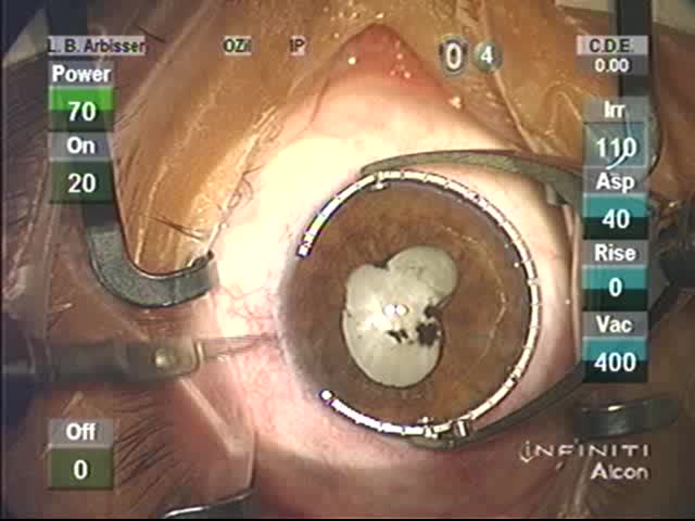White Cataract With Silicone Oil After Recurrent Retinal Detachment