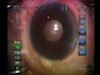 Using Sandwich Phaco Technique on Pseudoexfoliation Cataract
