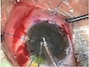 LenSx Management of Subluxated Cataract in Wiell-Marchesani Syndrome 