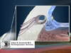 Trabecular Bypass Surgery with the iStent