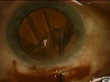Endocapsular Phacoemulsification