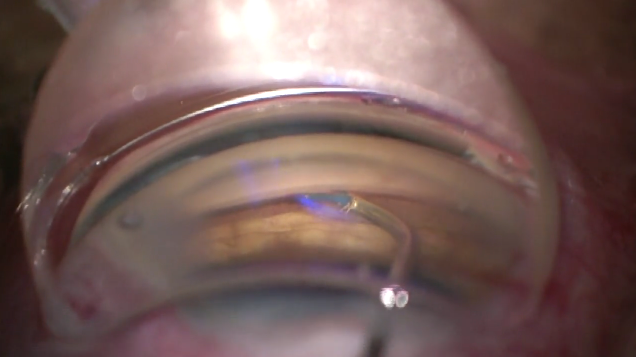Combining Mechanisms: Viscodilation, Trabeculotomy, and Hydrus Implantation